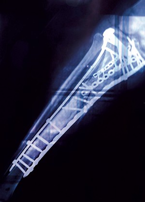 Benedetto's leg X-ray after 17 surgeries - COURTESY IMAGE