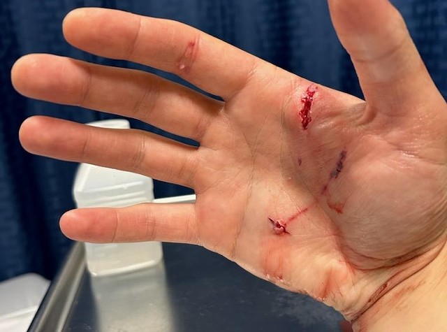 CJ Woods' hand after the bite - COURTESY OF CJ WOODS