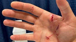 CJ Woods' hand after the bite