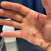 CJ Woods' hand after the bite