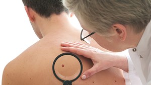 WTF: Why does Vermont have such a high incidence of melanoma?
